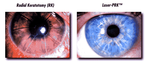 Radial Keratotomy vs. Laser-PRK